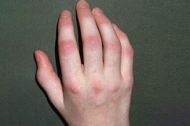 What are the 5 Diﬀerent Types of Psoriatic Arthritis?