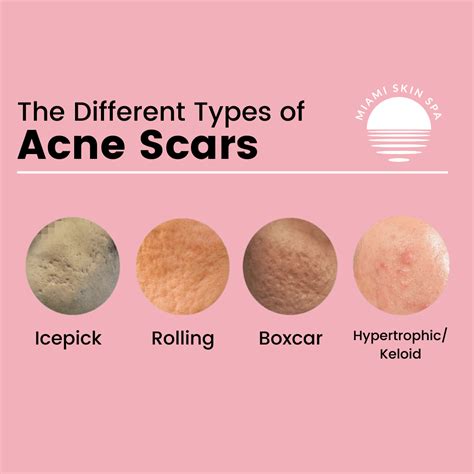 Types of Acne Scars: Pictures, Diagnosis and Treatments