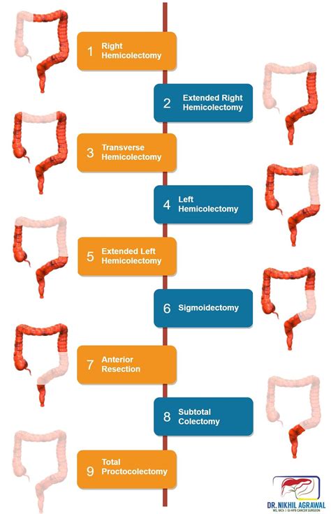 Colon cancer treatment: surgery | Colectomy | Dr. Nikhil Agrawal