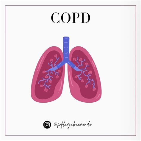 Emphysema stages symptoms complications and treatment – Artofit