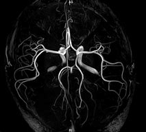 Image result for MRI Angiography