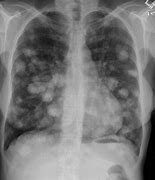 Image result for Multiple Lung Nodules