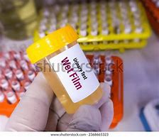 Image result for Muco Urine