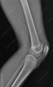 Image result for Normal Lateral Knee Radiograph