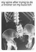 Image result for Lumbar Spine MRI Meme