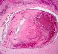 Image result for Thrombosis Histology