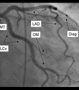 Image result for Angio Vue Choriocapillaris