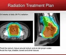 Image result for Radiotherapy Rectal Cancer