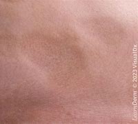 Image result for Atrophy Dermatology