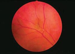 Image result for Arterial Emboli