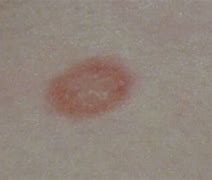 Image result for Circular Rash On Skin