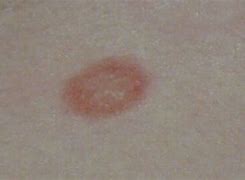 Image result for Raised Circular Lesion On Skin