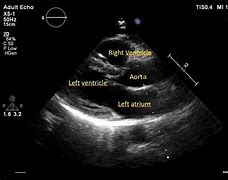 Image result for Right Ventricular Outflow Tract