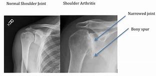 Image result for Arthritc Shoulder