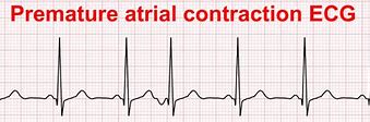 Image result for Premature Atrial Contraction