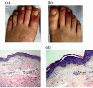 Image result for Acral Ischemia