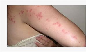 Image result for Benedryl Bug Bites