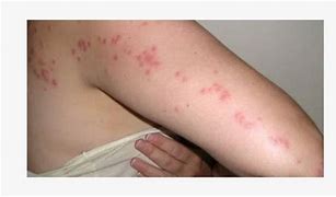 Image result for Bed Bug Bites Groin