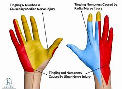 Image result for Radial Nerve in Hand