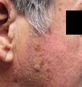 Image result for Skin Lesion Removal