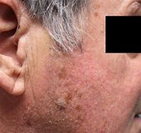 Image result for Trim Skin Lesion