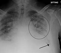 Image result for Pulmonary Edema Fluid Overload