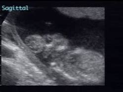 Image result for Anencephaly Ultrasound