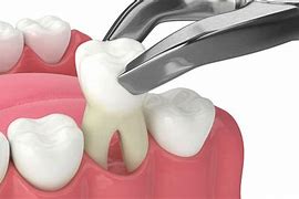 Image result for Alendronate and Tooth Extraction