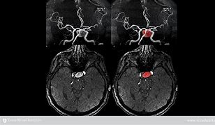 Image result for Aneurysm in MRI