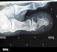 Image result for Broken Toe Bone