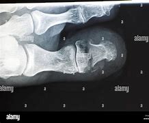 Image result for Broken Toe Bone