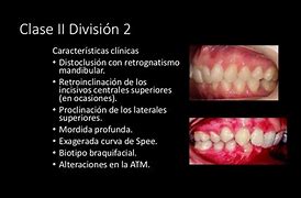 Image result for Tipos De Maloclusion