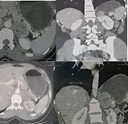 Image result for Pheochromocytoma CT Abdomen