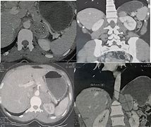 Image result for Large Pheochromocytoma CT