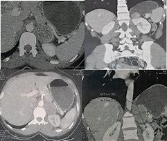 Image result for Pheochromocytoma On CT Scan