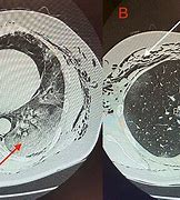 Image result for Coronal Lung CT