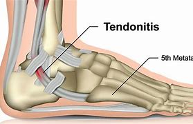 Image result for Tendons Near Lateral Malleolus