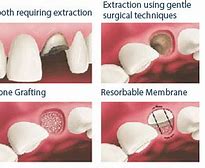 Image result for Tooth Extraction Painless