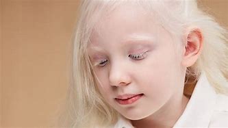 Image result for albino child eyes