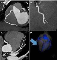 Image result for Angio CT Scan