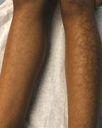 Image result for Dark Pigmentation On Legs