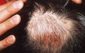 Image result for Build Up with Worms in Hair