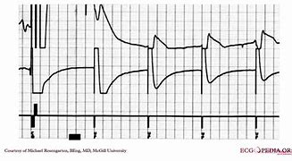 Image result for Ventricular Fibrillation EKG Examples