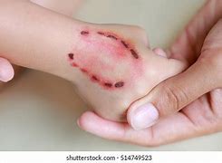 Image result for Severe Human Bite