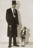 Image result for Gigantism Acromegaly and Dwarfism