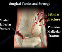 Image result for Trimalleolar Fracture of Ankle ICD-10