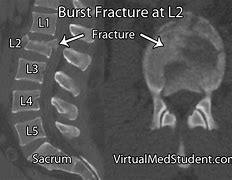 Image result for Lumbar Compression Burst Fractures