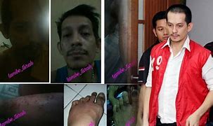 Image result for Gambar Orang HIV