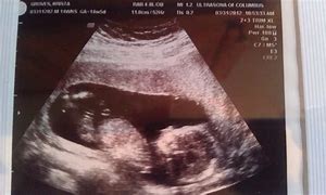 Image result for Baby Girl or Baby Boy Ultrasounds