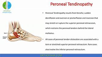 Image result for Peroneal Tendinopathy